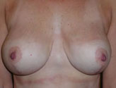 Patient # 88861 After Photo # 2